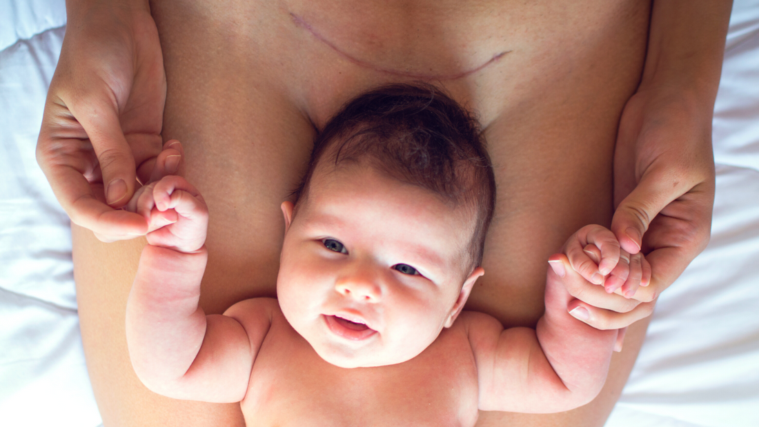 International Caesarean Awareness Month | New Beginnings